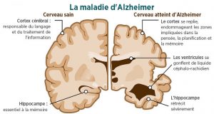 maladie alzheimer 1